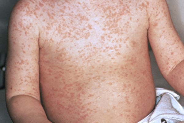 A child's torso covered in red spots, indicating measles