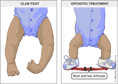 An illustration shows what a baby’s legs and feet look like with club foot and how the boot and bar orthosis is worn to treat club foot.