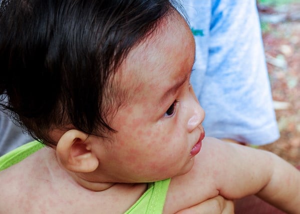 Toddler with red spots on face, indicating measles